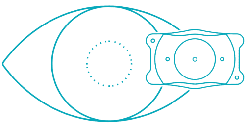 EVO ICL Lens Illustration