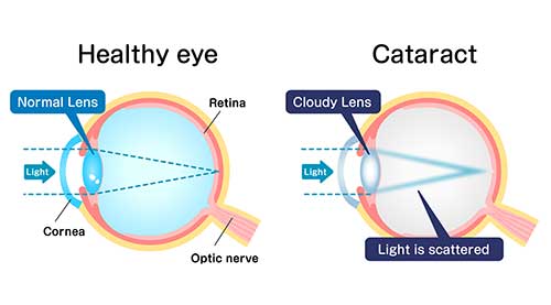 Cataract Illustration