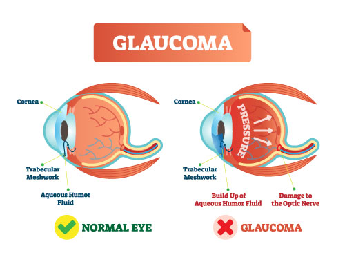 What is Glaucoma?