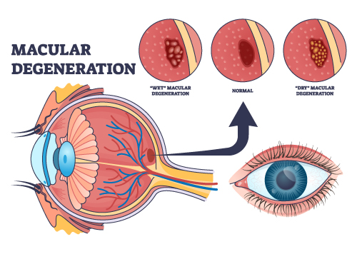 Macular Degeneration