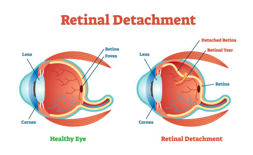 What is retinal detachment
